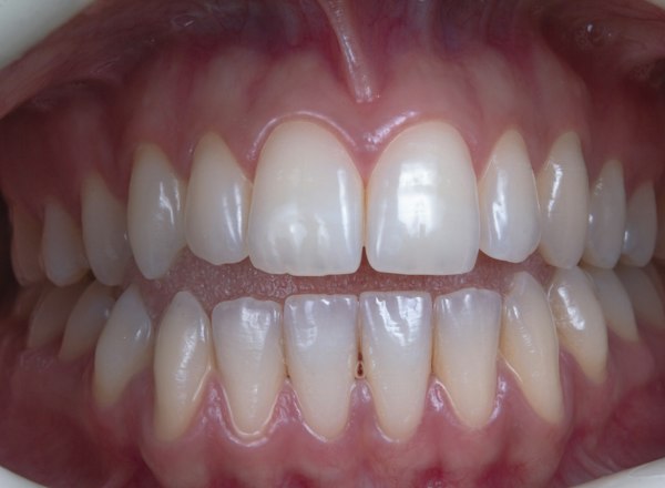 Straight teeth after 9 months of clear aligners