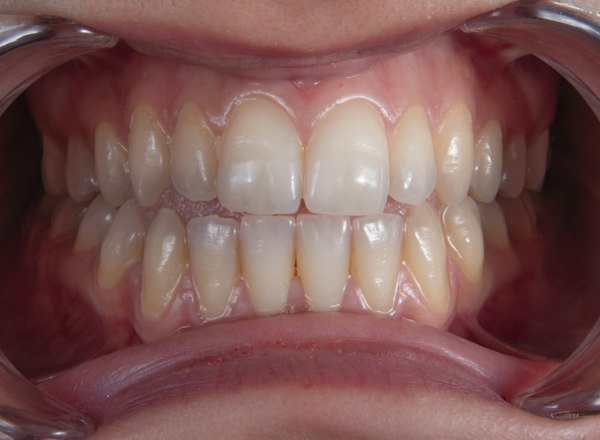 Teeth before clear aligner treatment