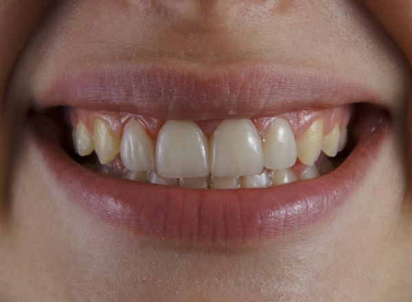 Smile before composite bonding